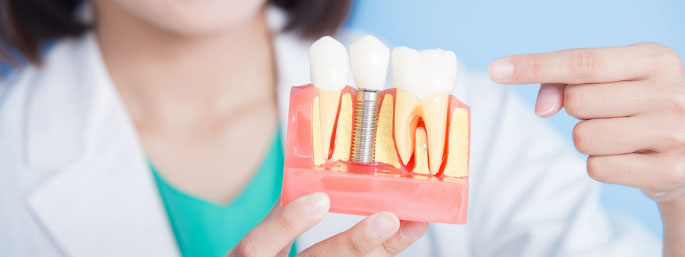 Porcelain crowns