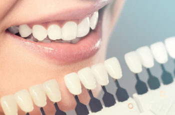 Different types of dental veneers