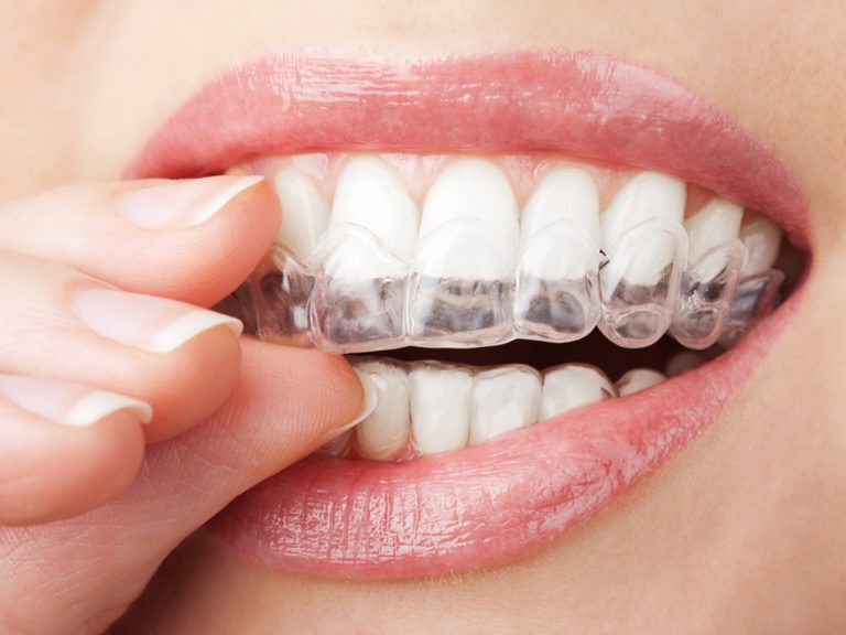 Grincement des dents la nuit découvrez les symptômes, les causes et les solutions! Clinique